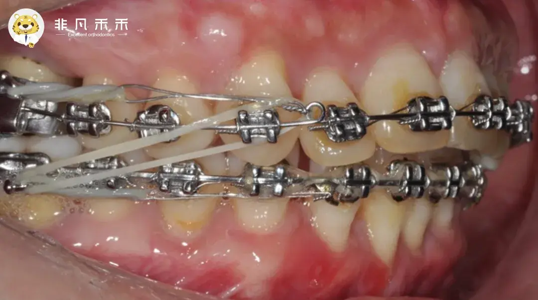 正畸二类牵引图片图片