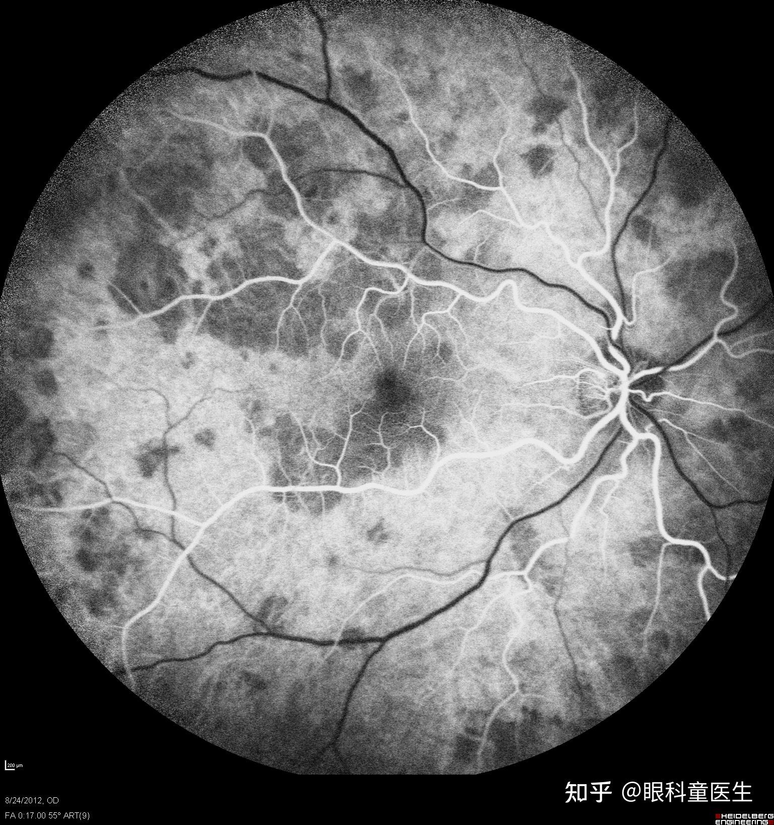 后葡萄膜炎——17、急性视网膜色素上皮炎 - 知乎