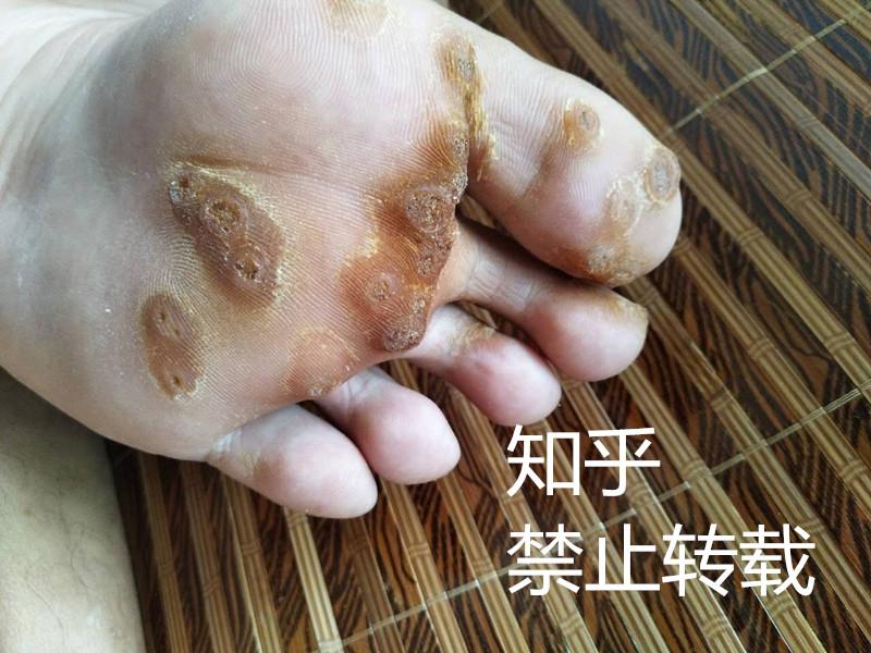 跖疣和鸡眼有什么区别,医学上有没有什么治疗