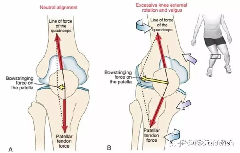 膝关节滑膜治疗方法你知道炎几种