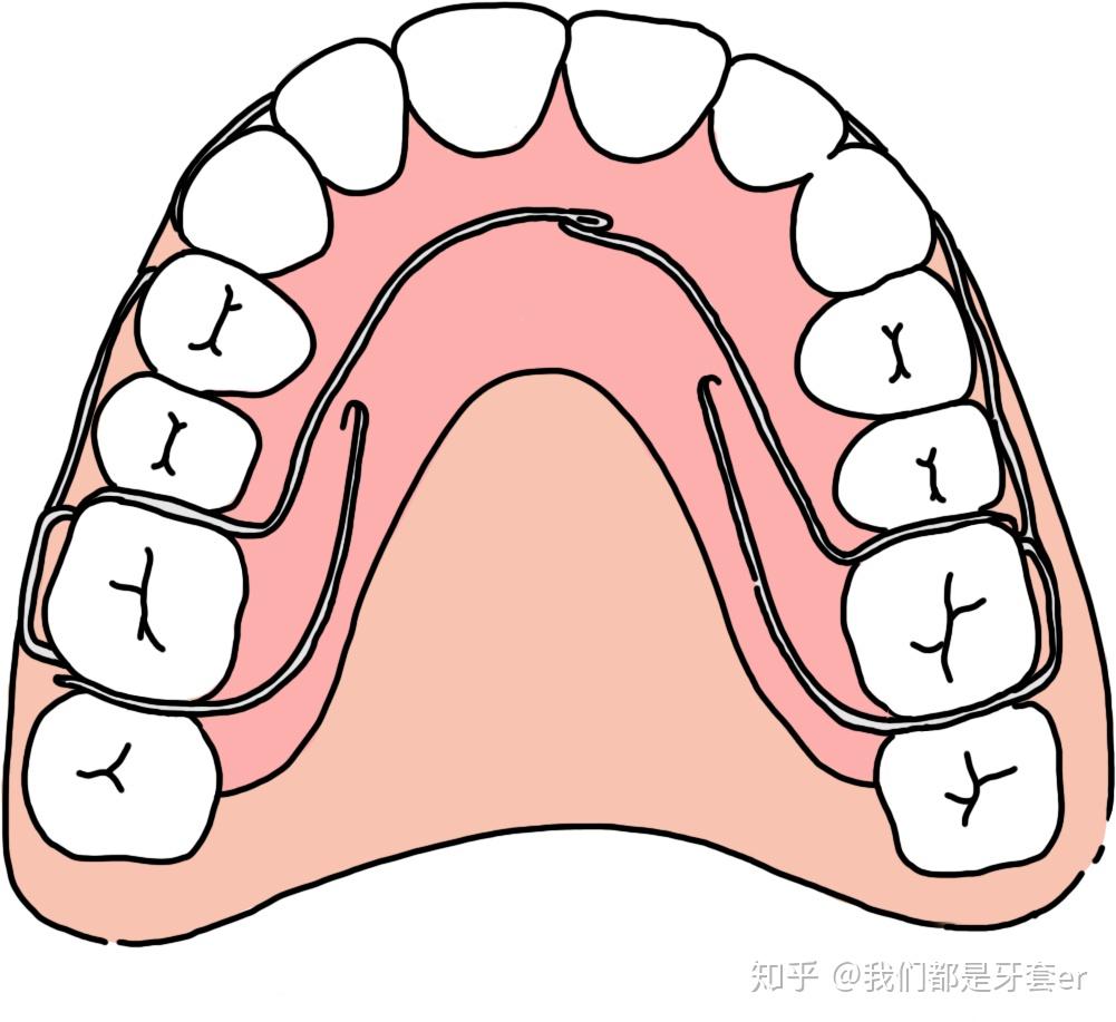 正畸攻略保持器的种类优缺点和佩戴时间