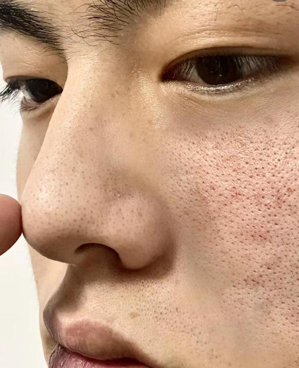 【男生毛孔粗大必看】男士收缩毛孔用什么最好最有效?医学生教你4步,1个月改善男生毛孔粗大、细腻紧致皮肤! - 知乎