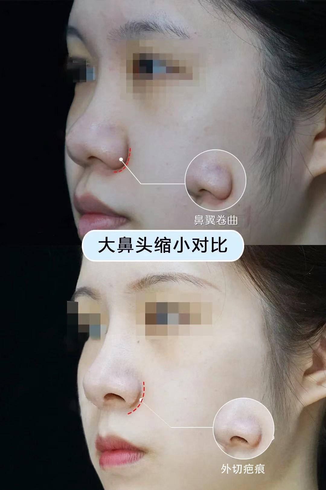 诱发隆鼻失败的原因有哪些 看看这些坑你有没有踩 知乎 诱发隆鼻失败的原因有哪些 看看这些坑你有没有踩 知乎