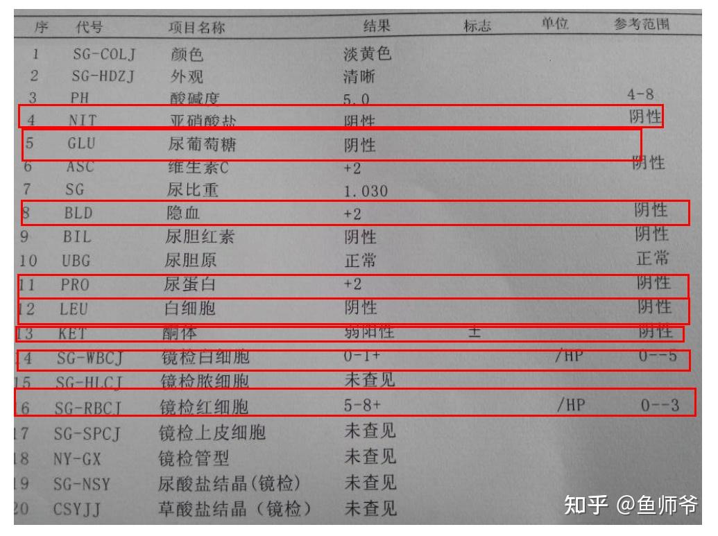 尿常规里面,我们平时重点关注:尿糖,尿糖白,尿隐血或尿镜检红细胞.