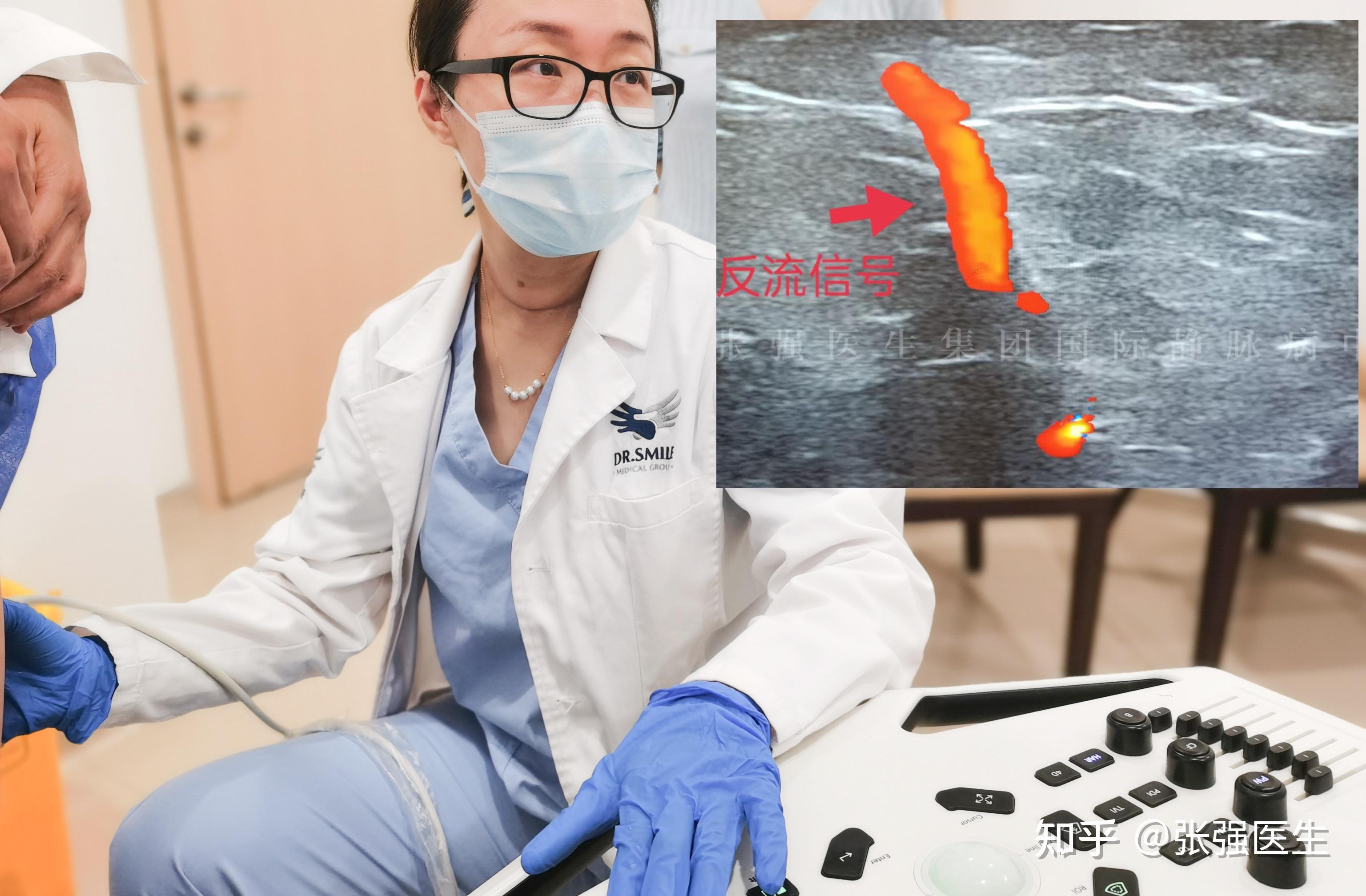 静脉曲张试了各种方法都失败,张强医生集团的chiva技术可以根治吗?