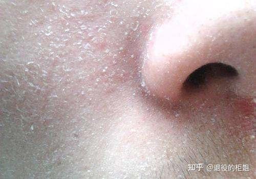 肌肤干敏、发痒、脱皮脱屑该怎么办？