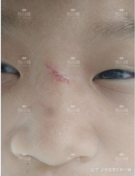 小男孩比较调皮所以鼻子上有了一个明显的疤色素沉着记录一下过程共勉