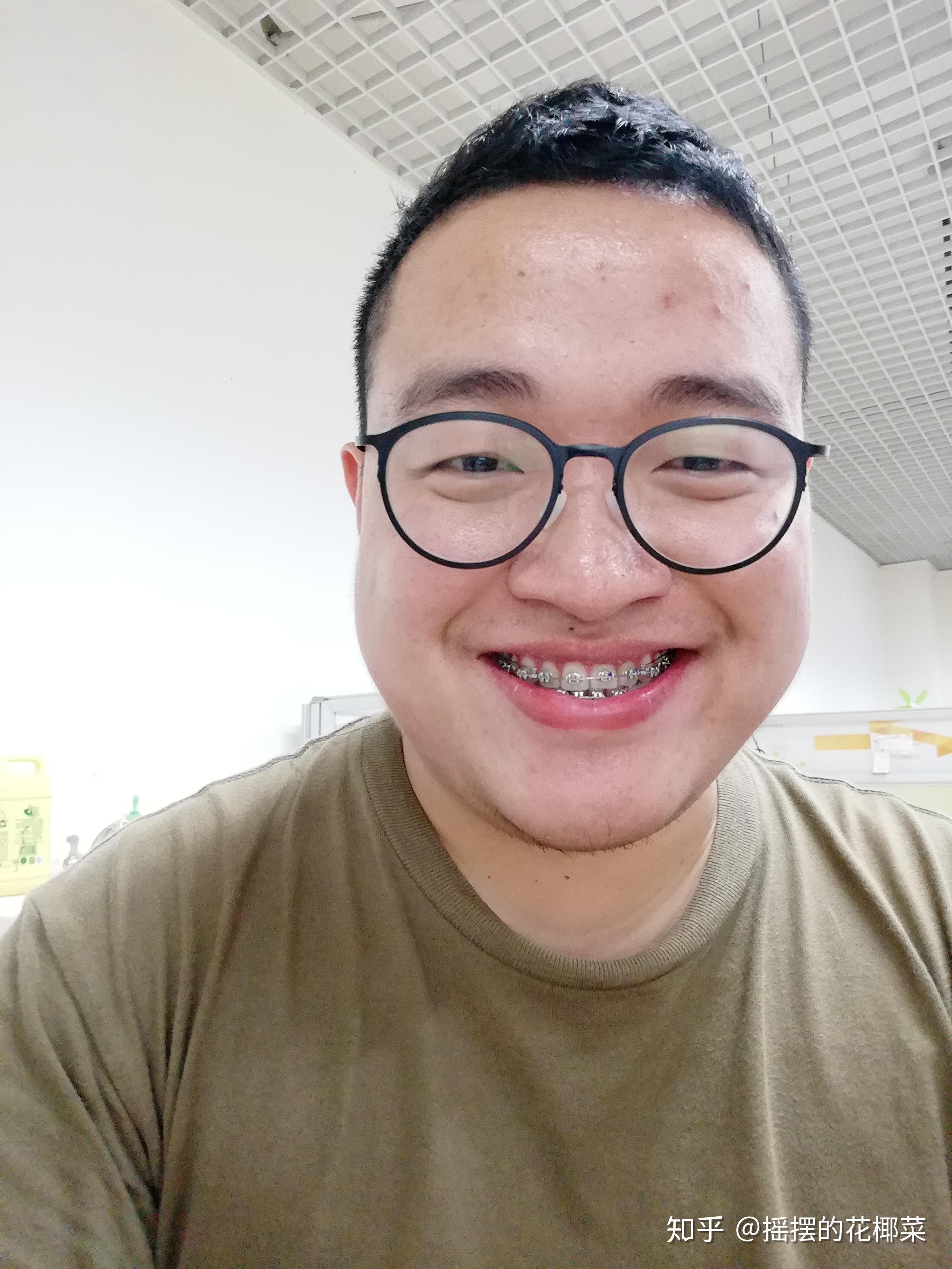 骨性反颌(轻微地包天)-对刃,中线不齐,牙齿缝隙大-26岁男-正畸记录