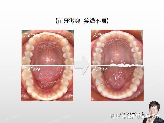 成都牙齒矯正李文星博士前牙微突笑線不調隱形矯正案例