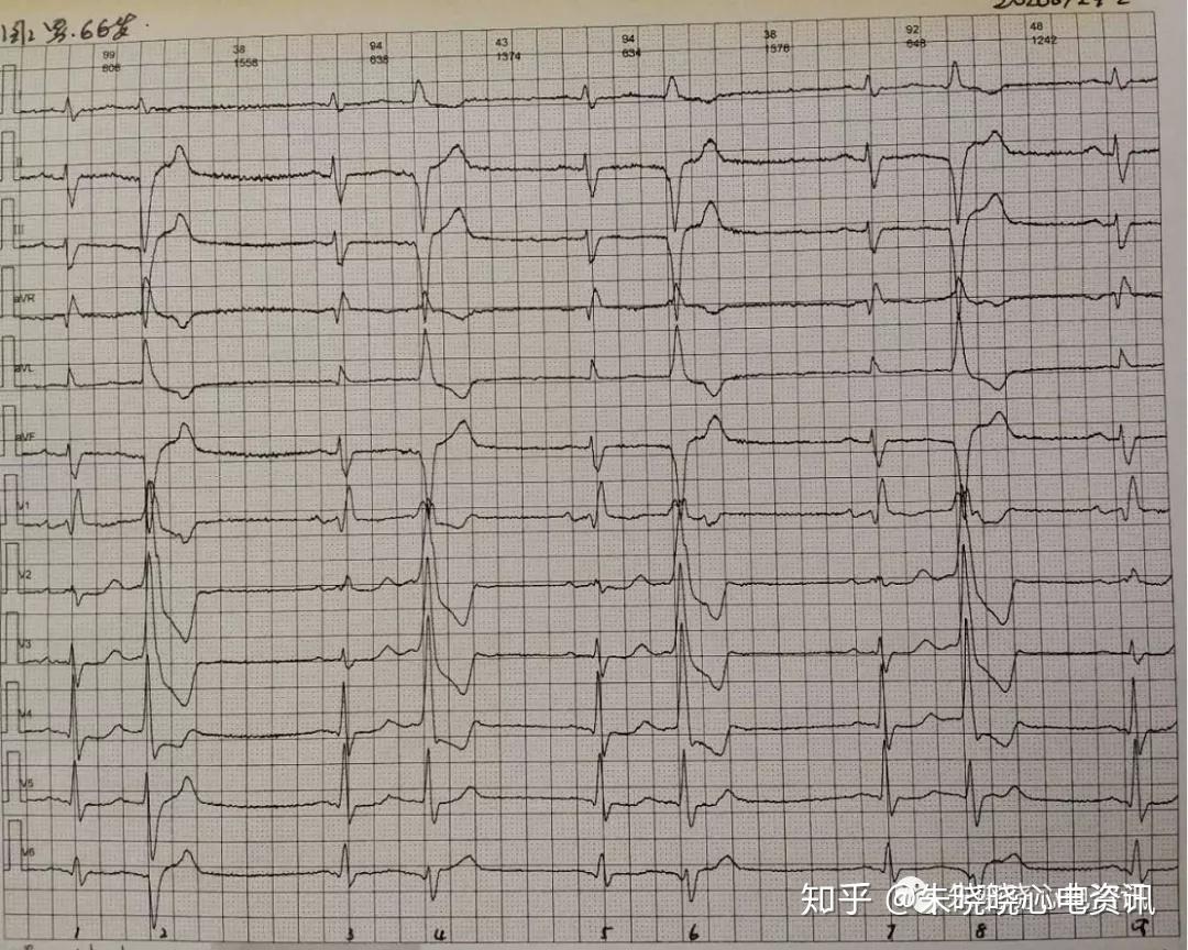 卢老师看心电图交界性逸搏多源室性早搏二联律6767672020729