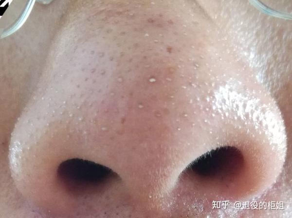 黑头到底是什么?究竟怎样去黑头才真的有效? - 知乎