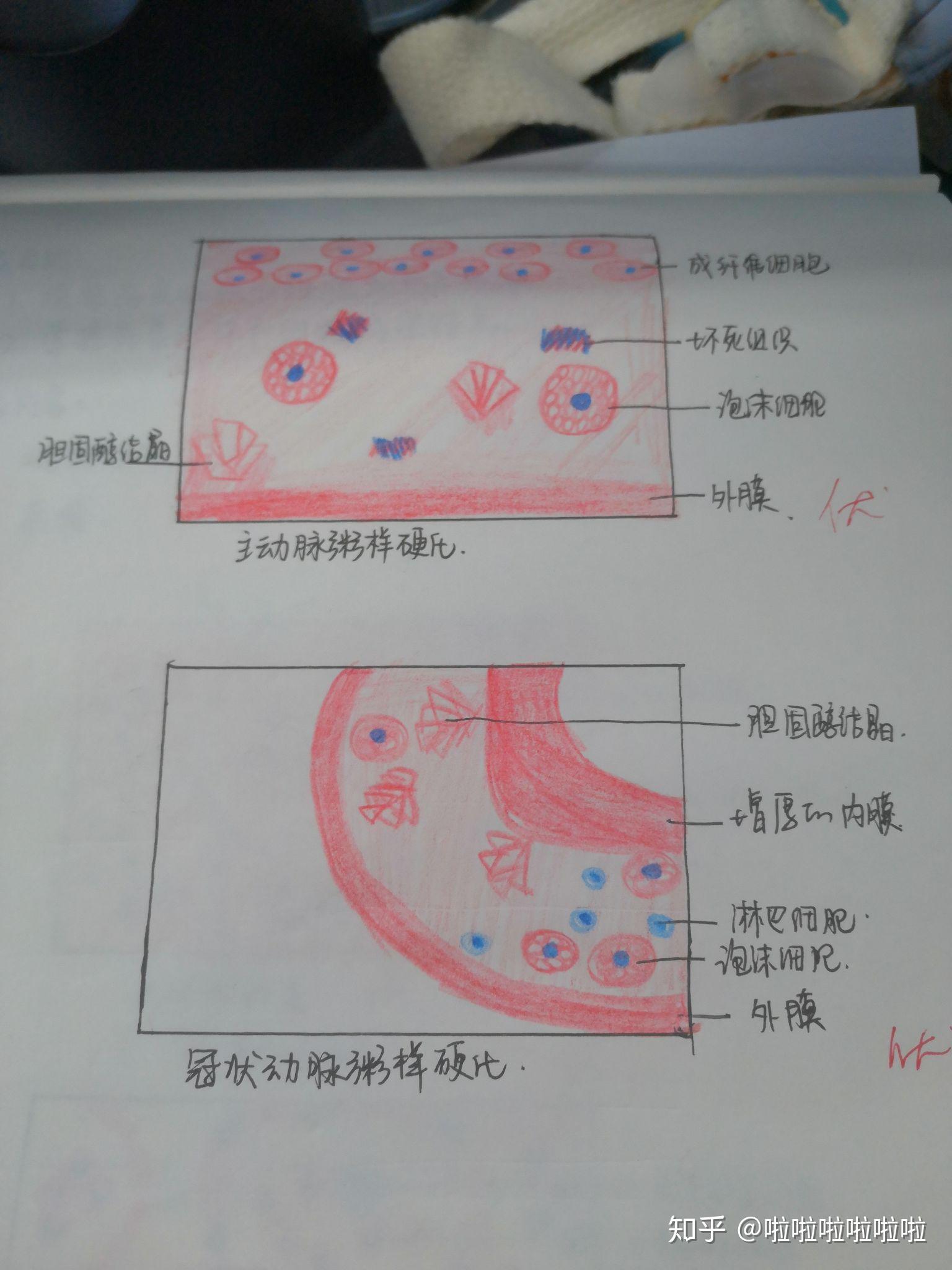 鼻息肉病理图片手绘图片