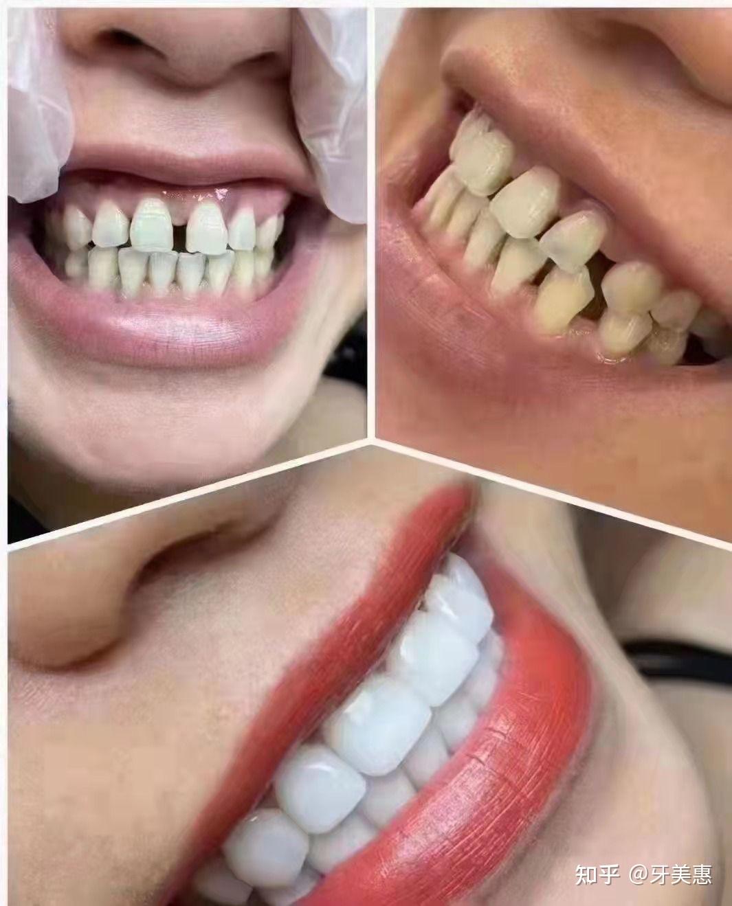 beli zobje