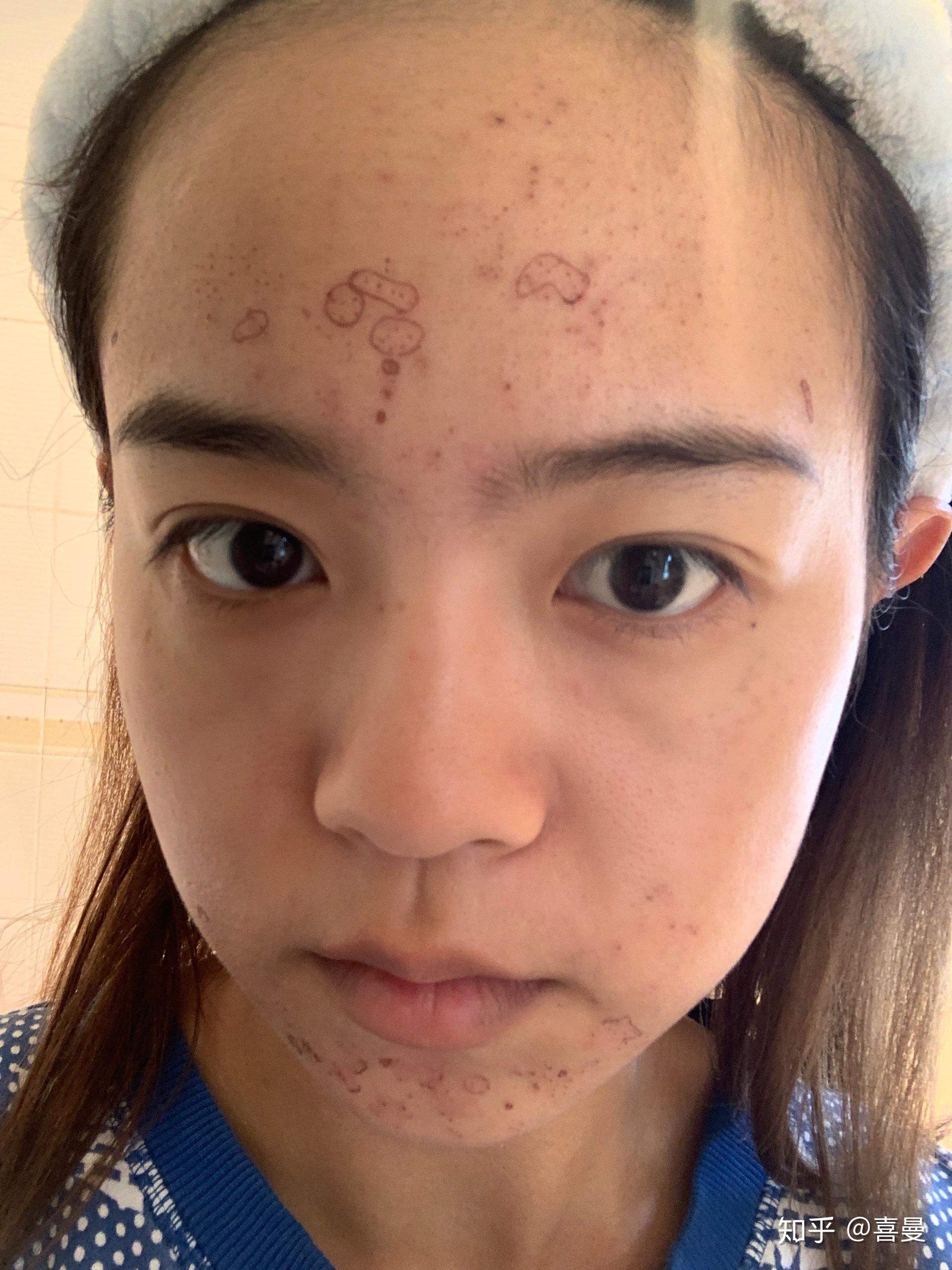 点阵激光治疗痘肌