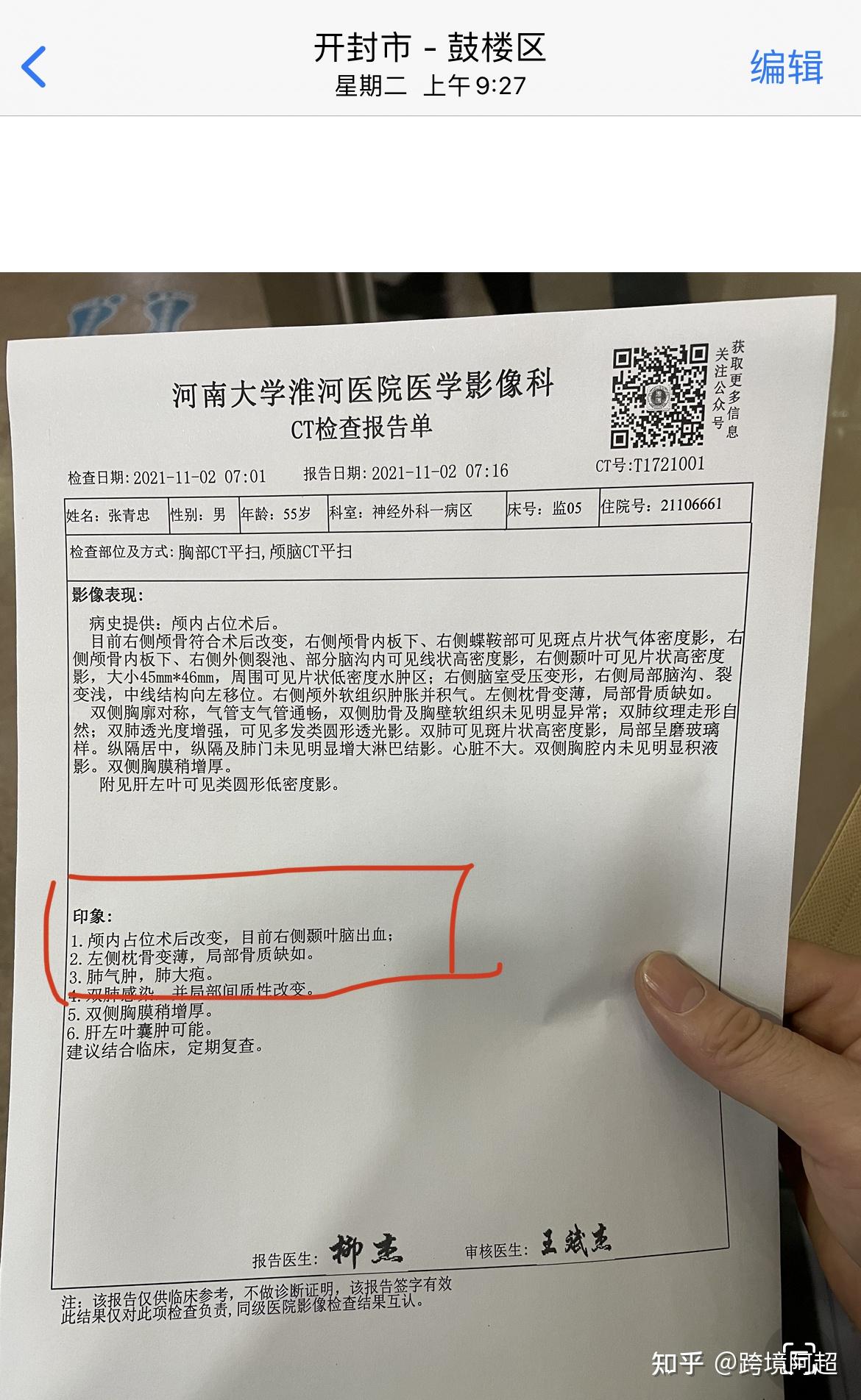 恶性脑胶质瘤有多可怕?放化疗是为了治疗还是续命?