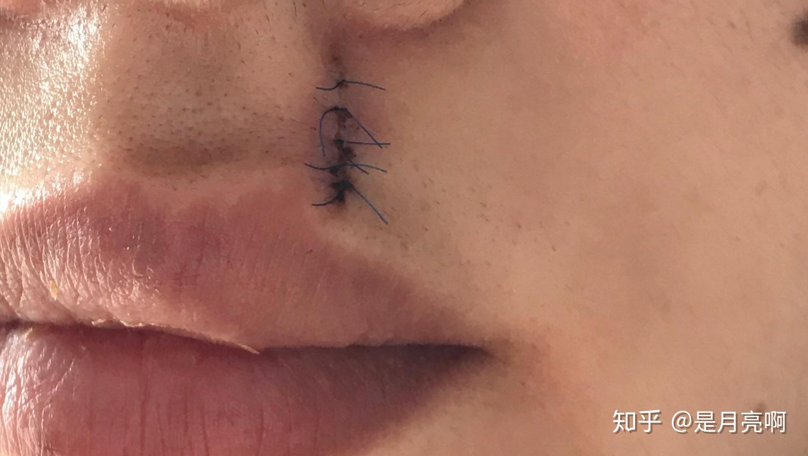 人中左侧唇峰上侧切痣全过程术前准备术后恢复详细记录