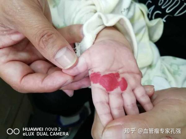 脉管畸形的分类- 知乎