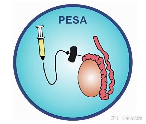 陪伴呵護!為什麼要做睪丸穿刺檢查