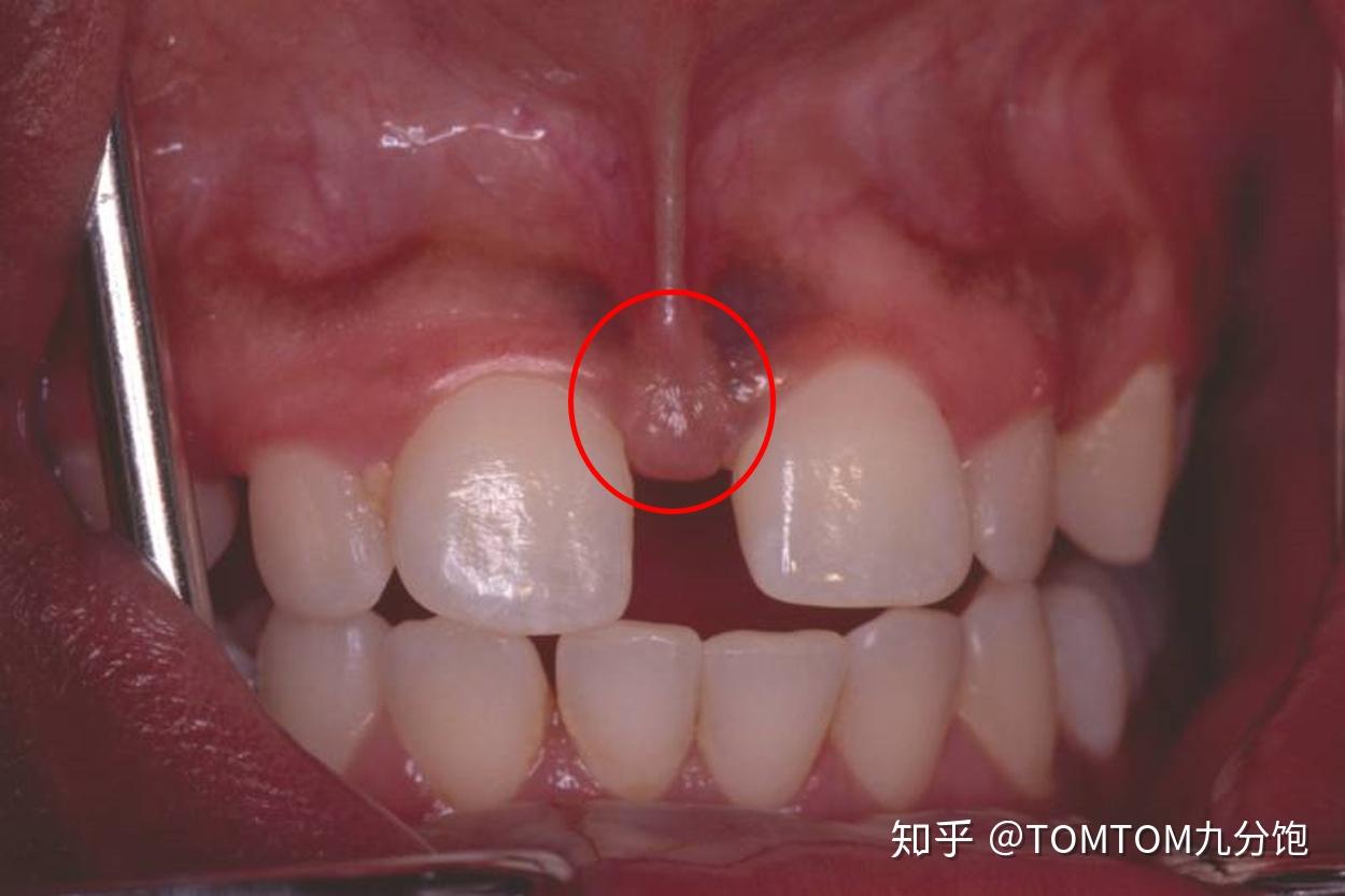 上唇系带是指在上唇内面的正中线上