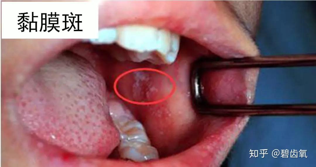 甚至舌侧边缘一毫米左右宽的蓝黑色线条很可能是铅中毒.