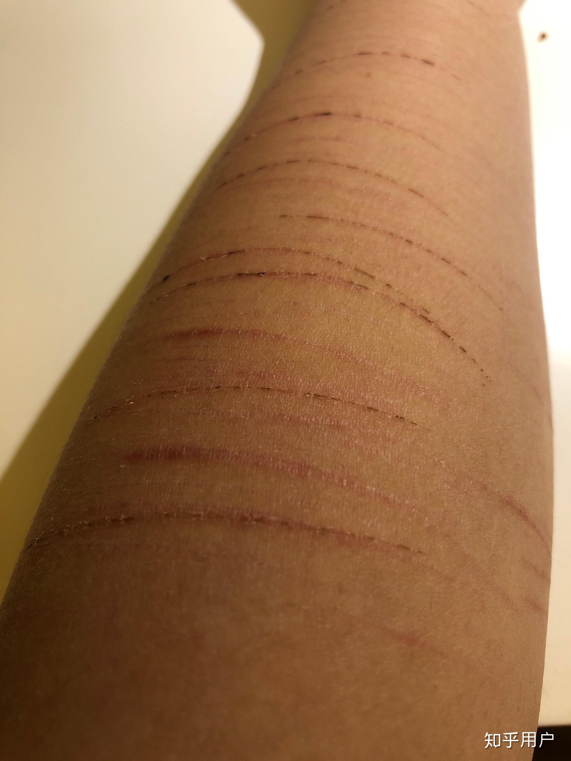 怎么遮自残的伤疤