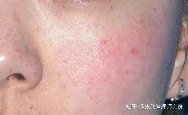 皮肤屏障受损自救指南一看就会