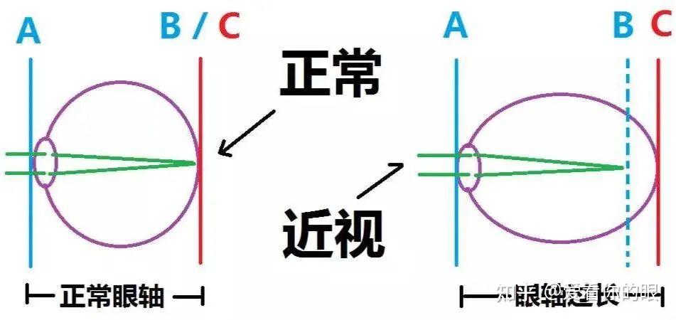 近视度数高的人,你的眼底可能已经「裂」了 - 知乎