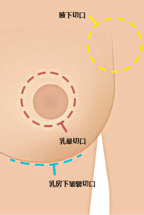 是自体脂肪隆胸痛还是假体隆胸更痛?痛感受哪些因素的影响?