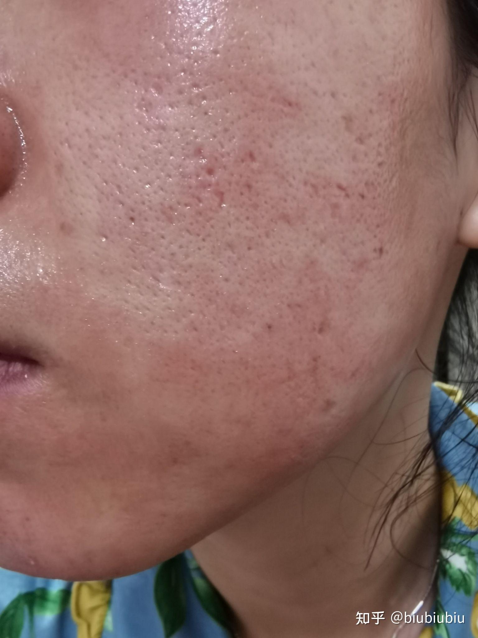 点阵激光后多久有效果脱痂了后就是最终效果么