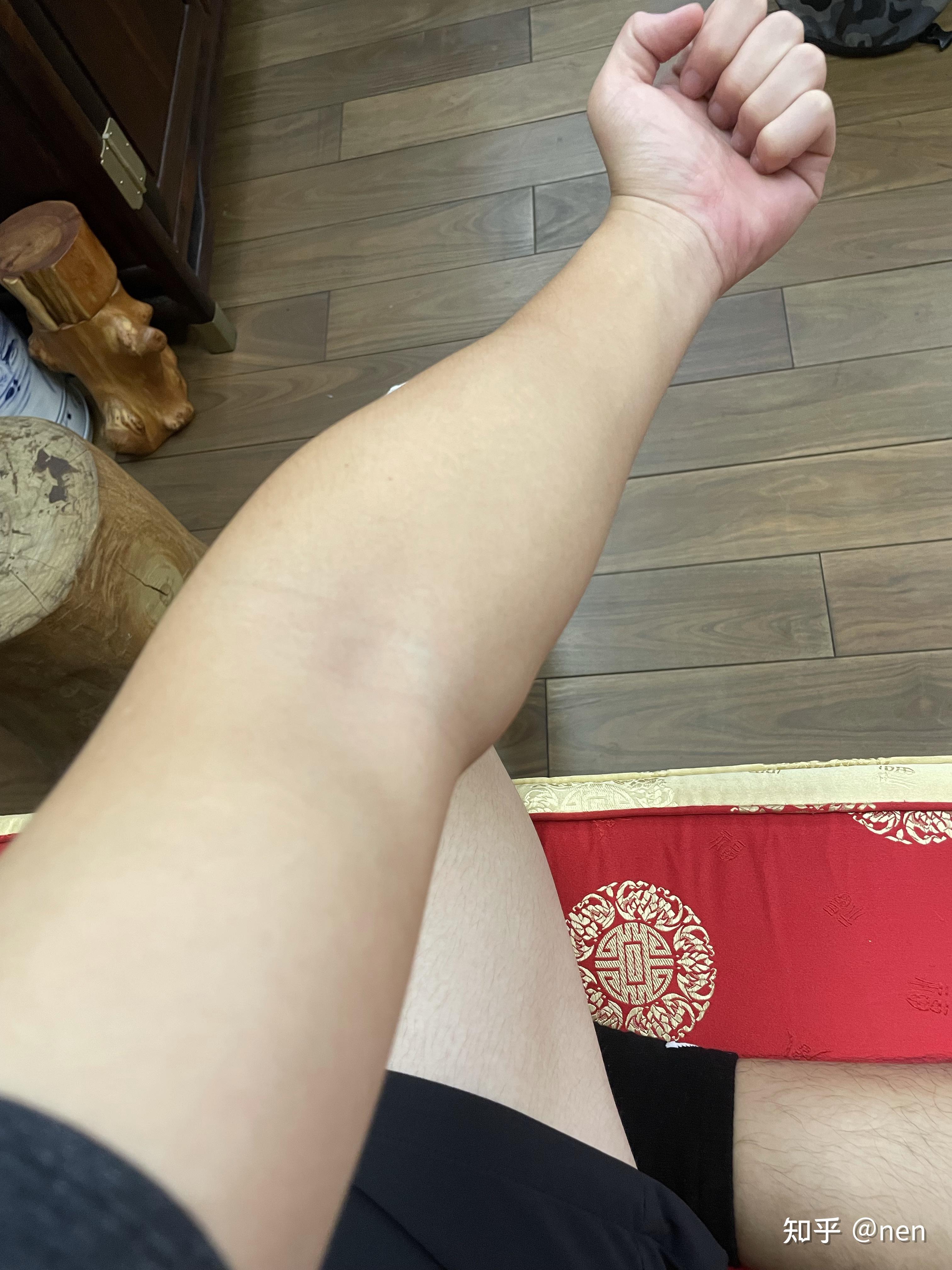 肘内翻这种程度需要手术矫正吗