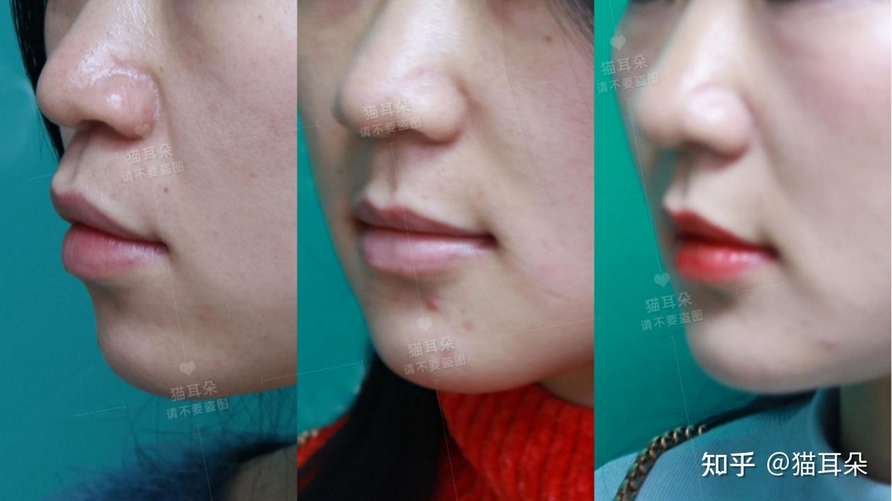 正颌手术风险大吗?