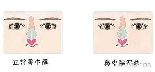 鼻中隔偏曲要怎么治疗最好？快来看看这个 知乎