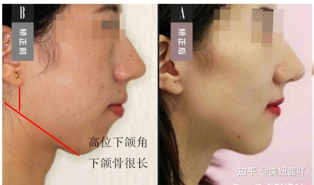 做正颌手术有哪些风险想做正颌之前先看看这篇