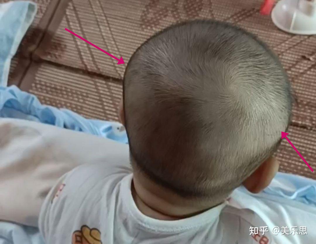 婴儿后脑勺有凹陷（婴儿的头总是偏向一侧有问题吗）-幼儿百科-魔术铺