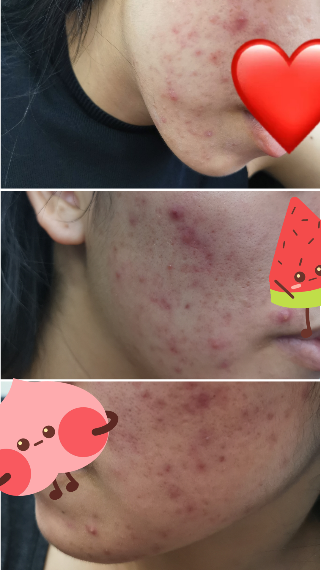 异维a酸治疗历程