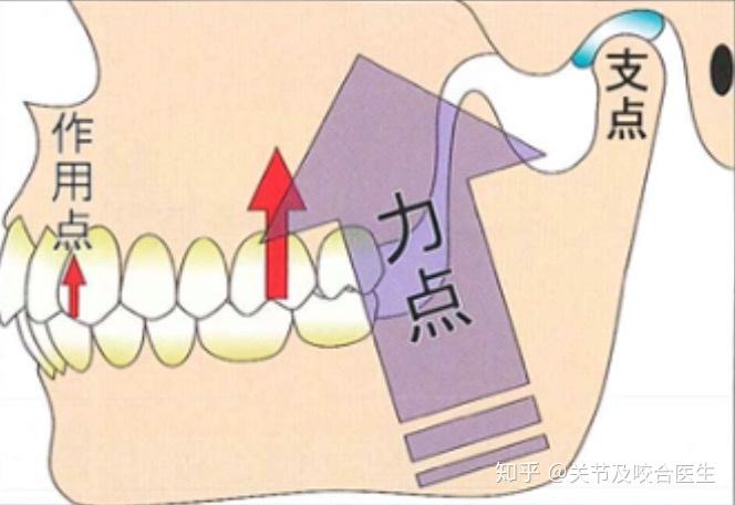 牙齿也是趋向于开合,在此提醒牙医及家长们此类矫治器不建议长期戴用