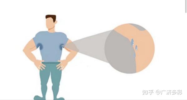 腋下、肛周皮肤反复长包流脓，警惕化脓性汗腺炎 - 知乎
