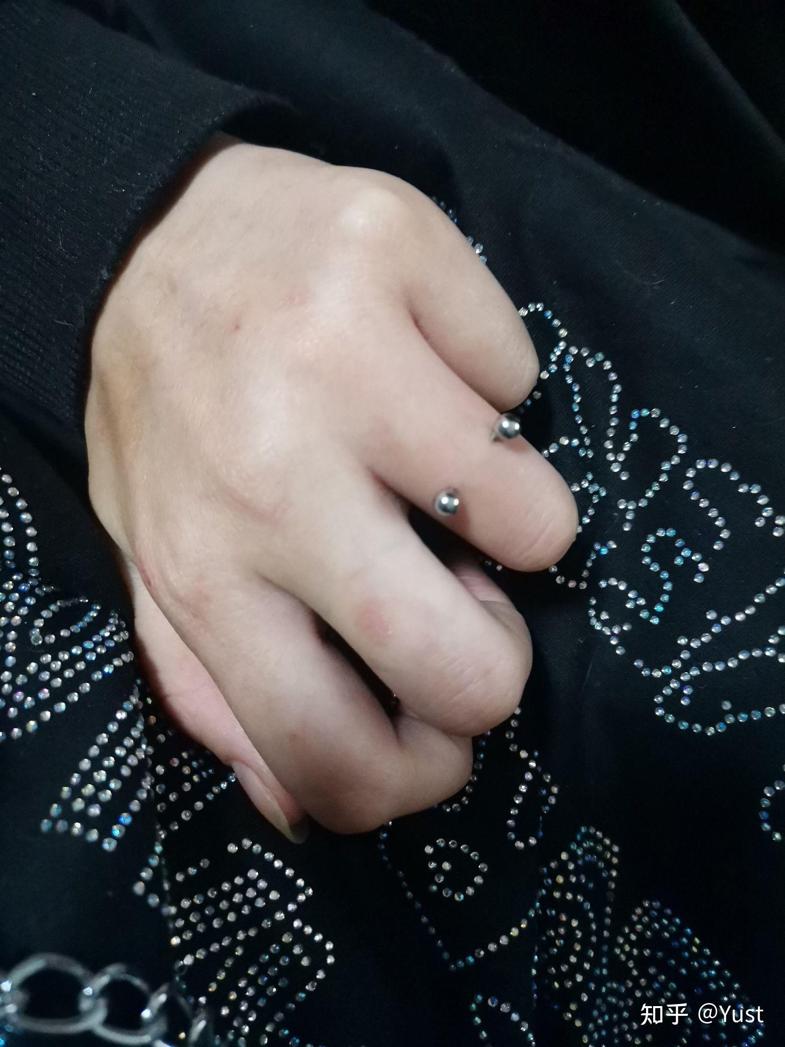 手指钉orward helix恢复记录 - 知乎