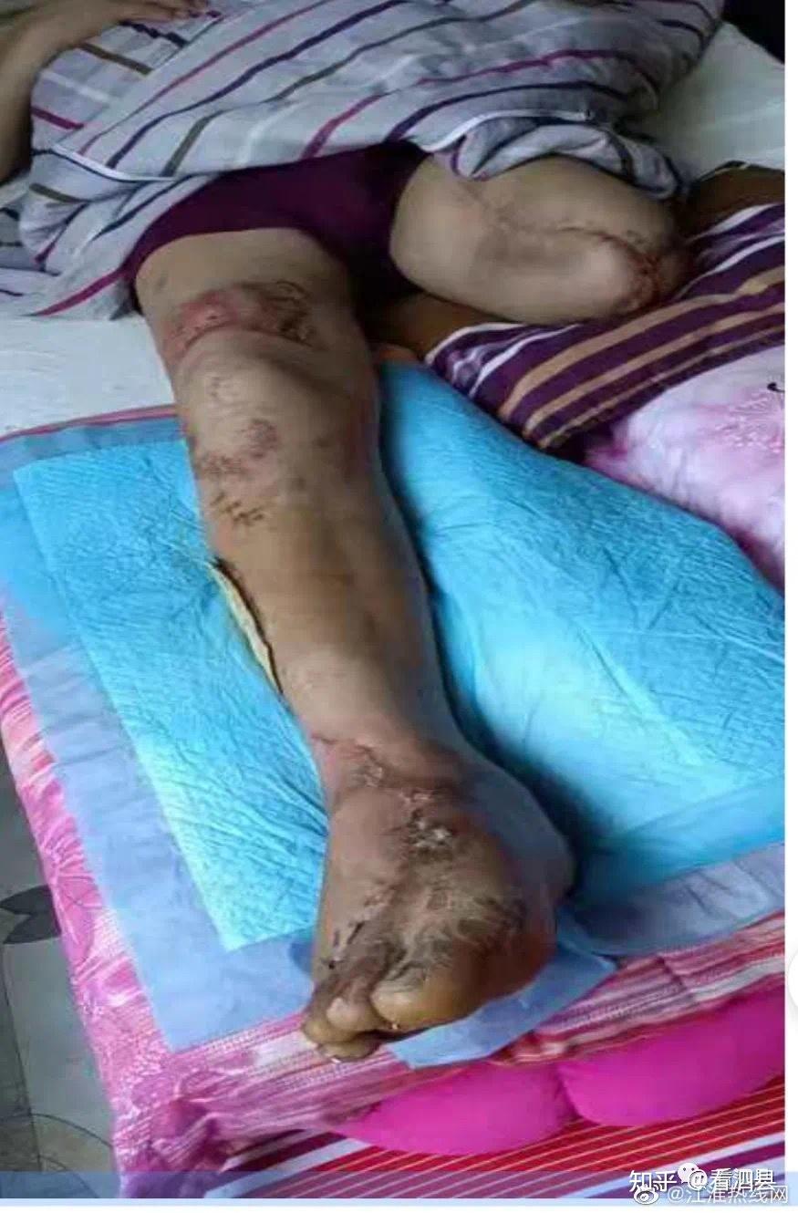 右腿多处粉碎性骨折,小腿及脚面血肉模糊,创面严重感染