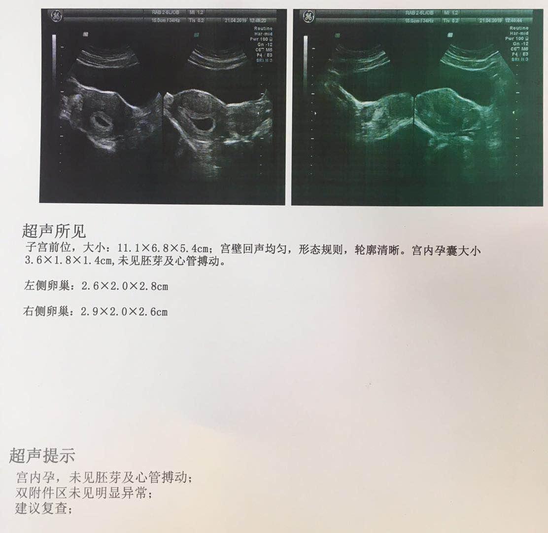 医生说 要是下周还看不见胎心胎芽 就给我开人流单子 知乎