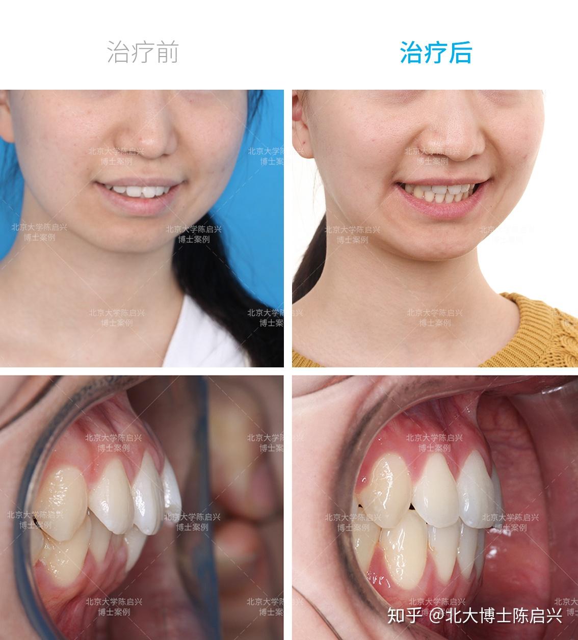 牙齿矫正案例:高角 骨性下颌后缩 