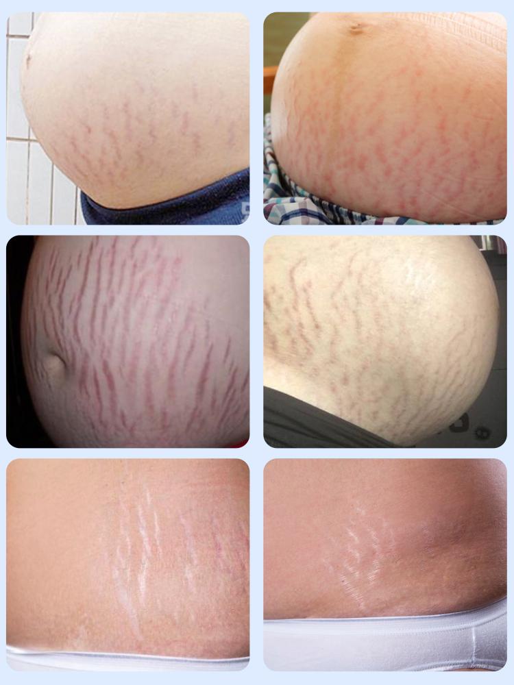 超全妊娠纹修复攻略