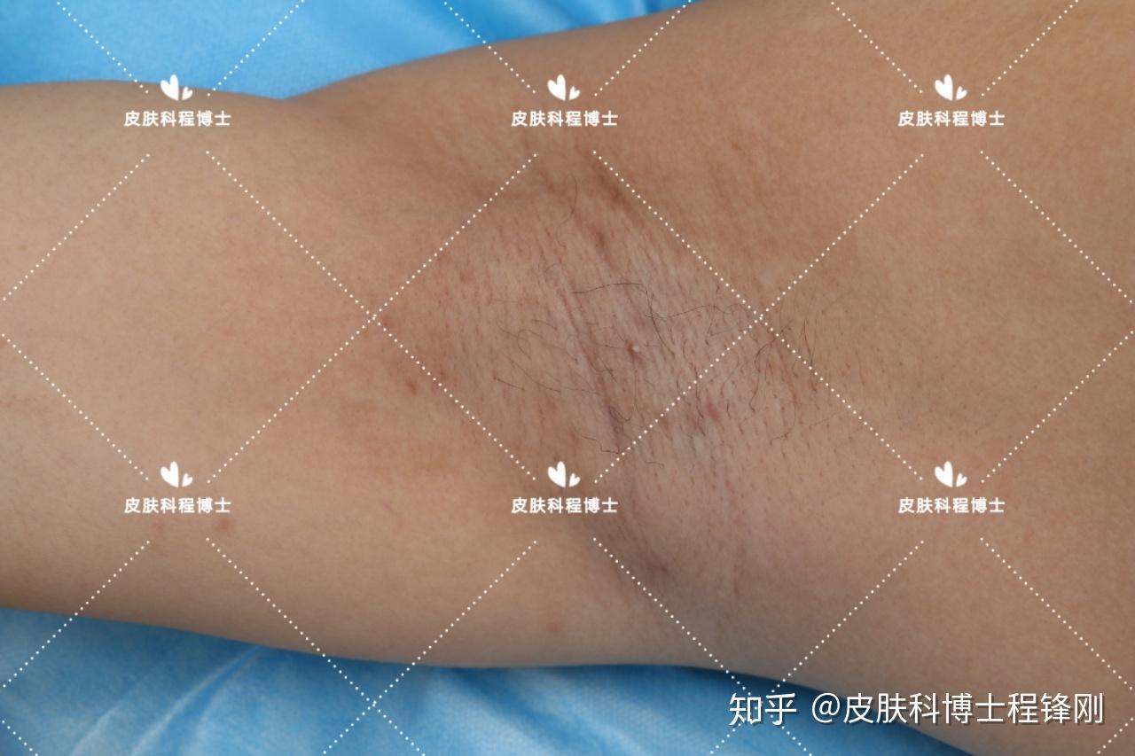 25岁狐臭男生双侧腋下味道严重案例8