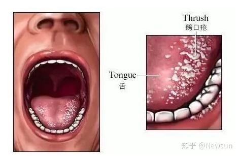 鹅口疮是感染性疾病,主要是由口咽部念珠菌过度增殖引起