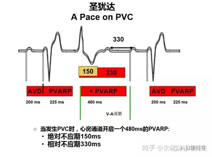 圣犹达起搏器对室性早搏的处理方式