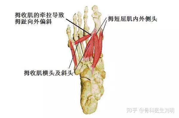 走红毯假摔其实她是因为拇外翻