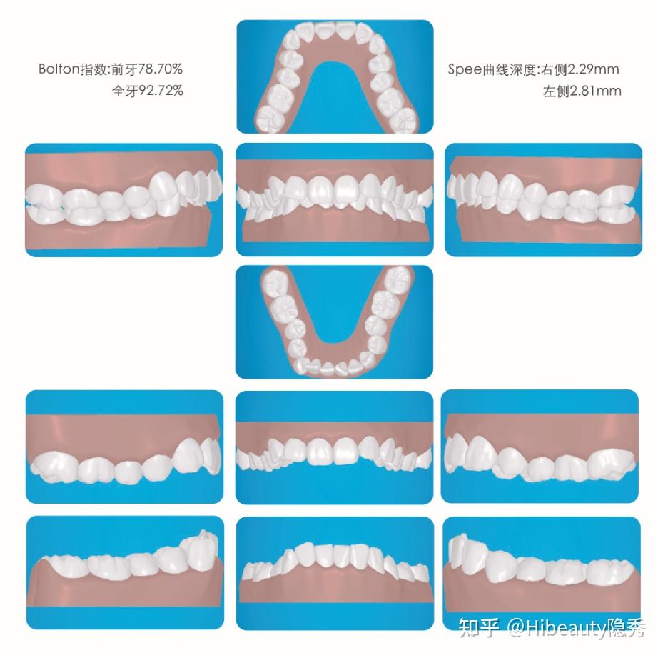 牙弓形态分几种图片图片