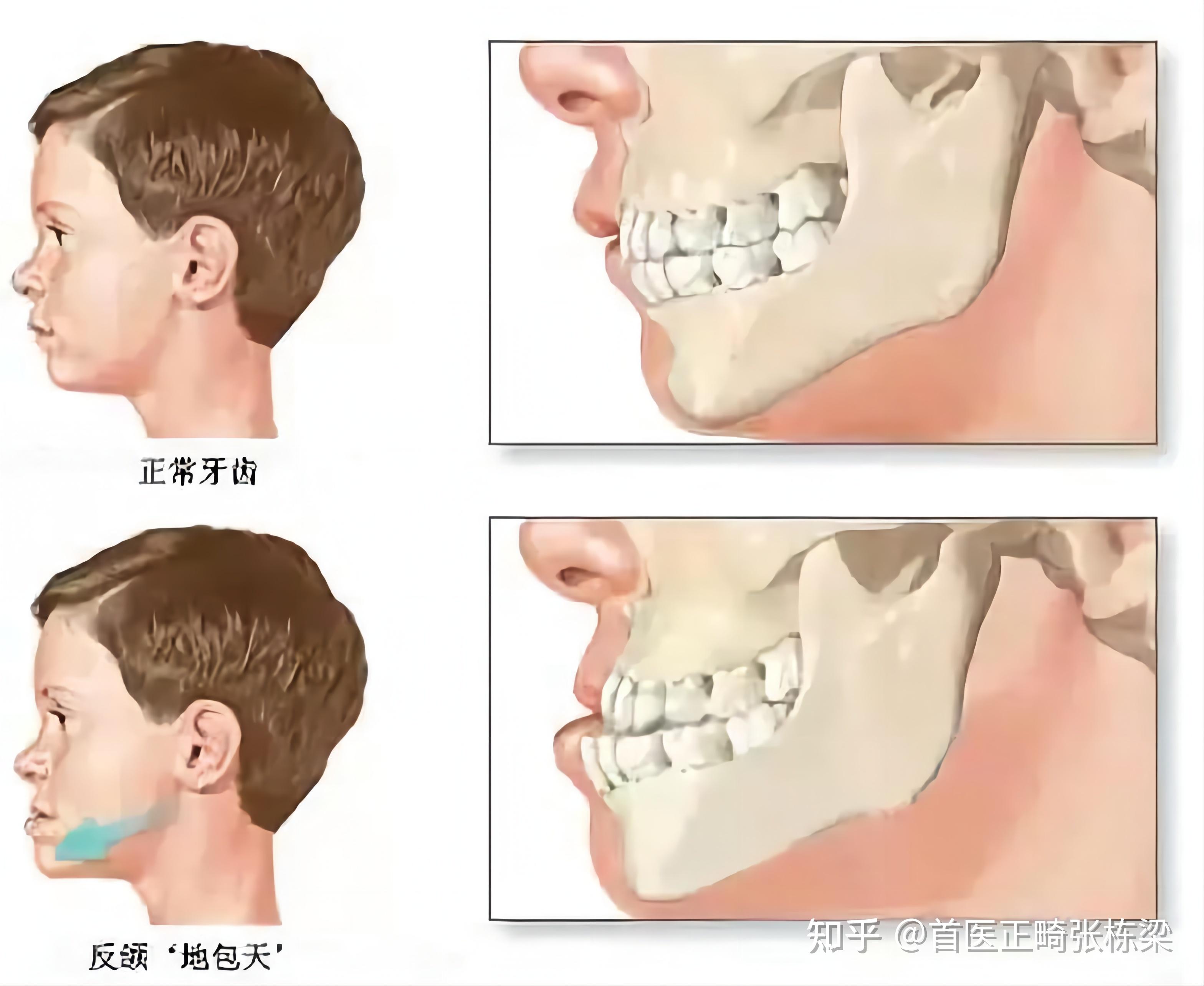 儿童颌骨矫正图片