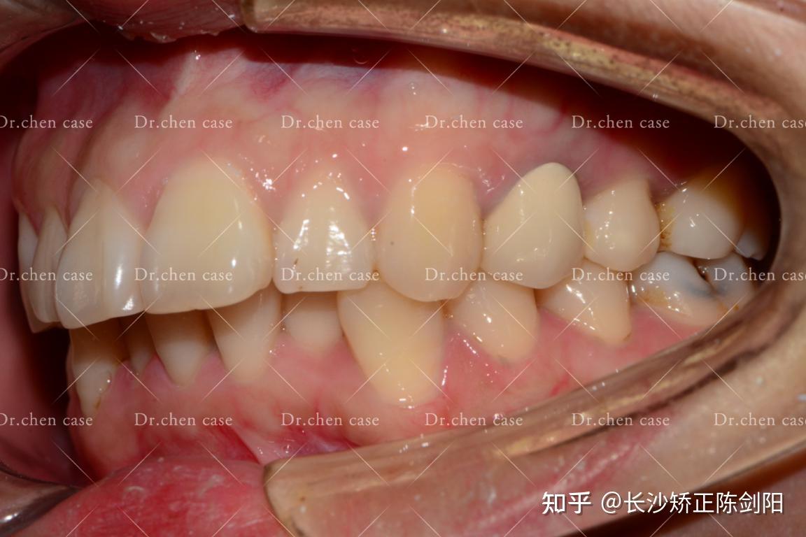 深覆盖会引起下巴后缩吗?在长沙能矫正吗?