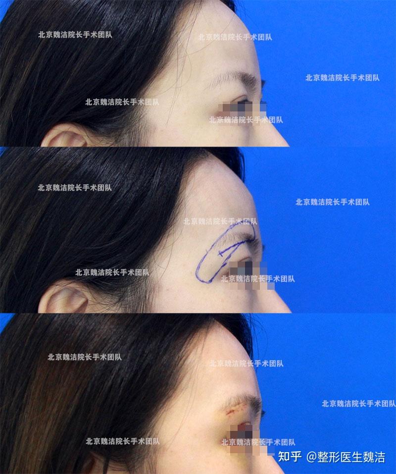 假体垫眉弓拆线时的切口和肿胀情况大概什么样? - 知乎